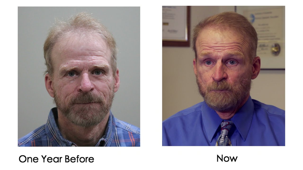 Dr Trudell Hair Restoration McCracken Hair Surgery YouTube