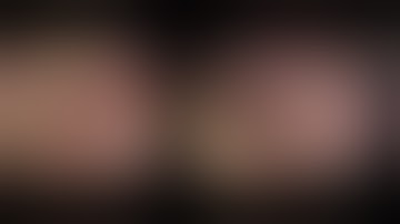 Laparoscopic left partial nephrectomy for RCC