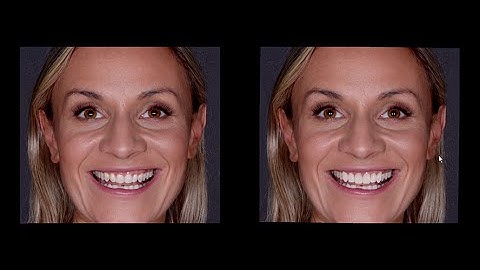 Planmeca Romexis® Smile Design: New features in version 4.4