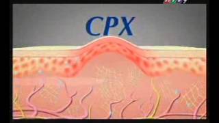 Download lagu 08 07 13 DERMATIX Dimming Scar Cream DERMATIX ULTRA 15s REVISED TVC Archives