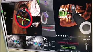 Implantologia Avanzata X-Guide