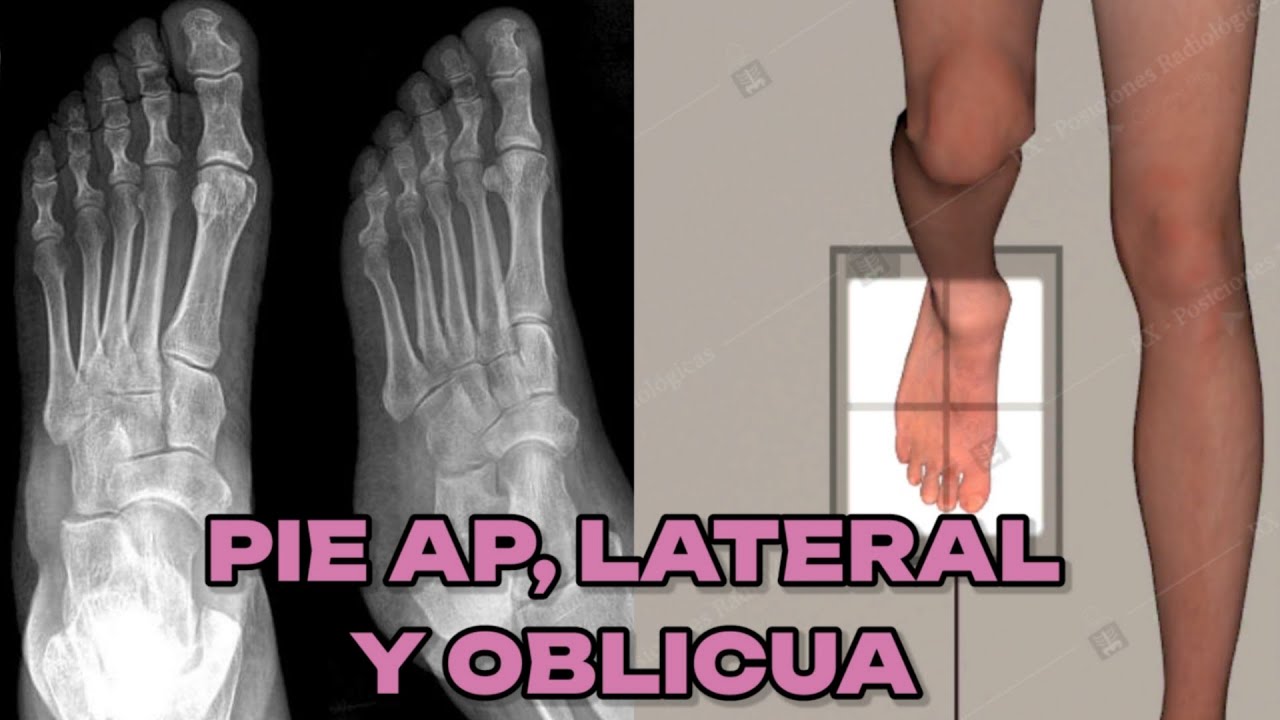 RADIOGRAFÍA DE PIE AP, LATERAL Y OBLICUA (MANUAL DE BOLSILLO) #6
