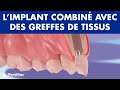 Implant combiné avec des greffes de tissus durs et mous ©