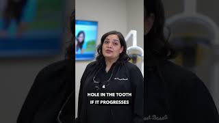 What Does A Cavity Look Like?