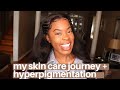 MY ACNE + HYPERPIGMENTATION SKIN CARE JOURNEY | Part 1