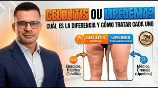 Celulitis o lipedema cual es la diferencia y como tratar cada uno