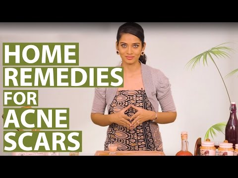 ACNE SCAR REMOVAL AT HOME | Get Rid Of Acne Scars On Face