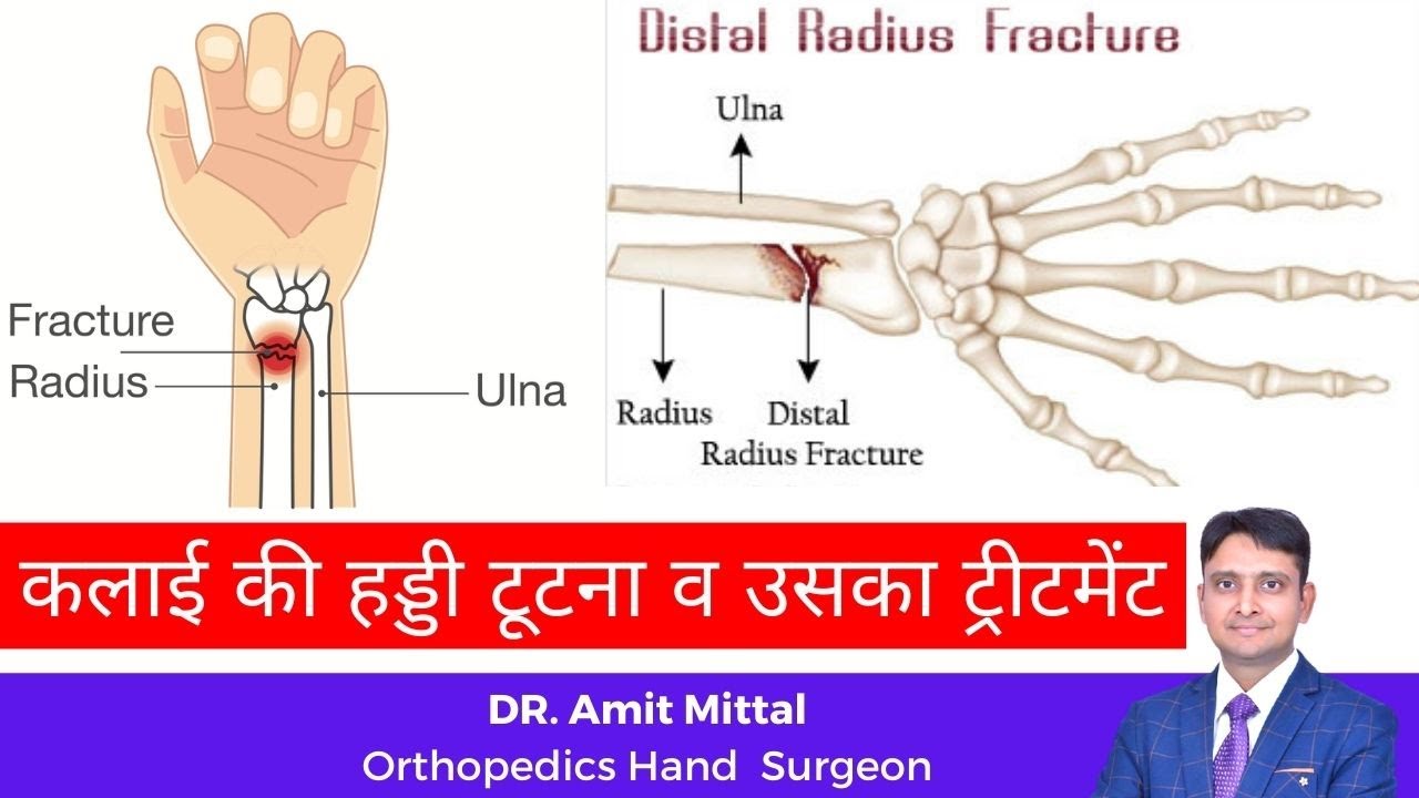 Distal Radius Fracture wrist fractures explained in simple hindi