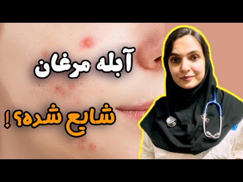 آیا آبله مرغان شایع شده واکسن آبله مرغان کجا هست از کجا زونا میگیری