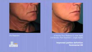 Ulthera Before and After Photos - Ultherapy at the office of Dr. Victor Michalak