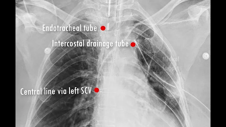 Chest X-ray: Tubes/ Catheters