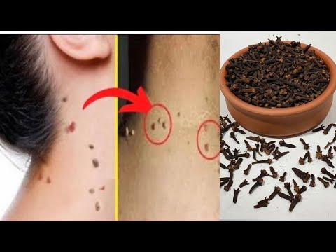 The recipe for getting rid of warts and spots on the skin forever is in this video. 100% exact solut