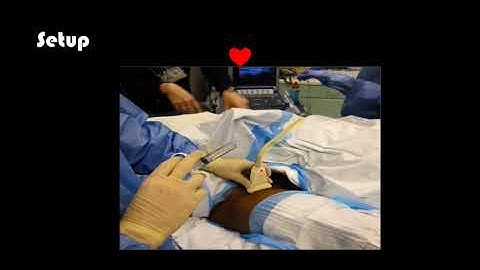 Introduction to US Guided Nerve Blocks Part III