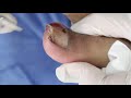 Ep_2308 Toenail removal 👣 คลิปนี้ห้ามมี 1 2 3... (2) 😷 (This clip is from Thailand)