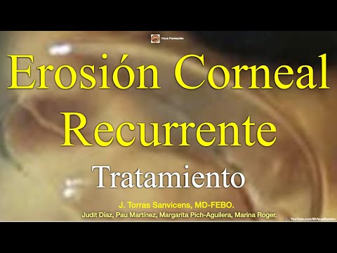 Video: ¿Desaparece la erosión corneal recurrente?