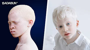 ¿Los albinos pueden oscurecerse?