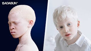 ¿Cuántos años vive una persona con albinismo?