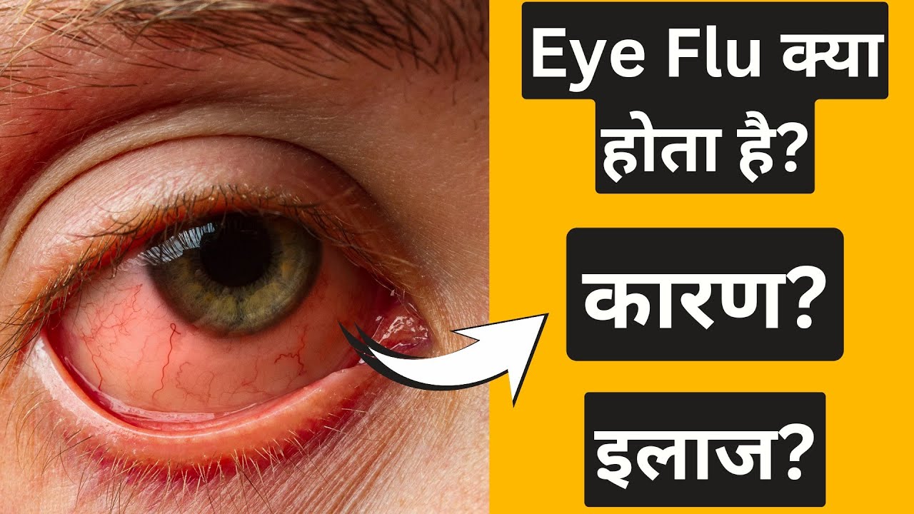 Eye Flu kya hota hai? Eye flu kaise hota hai? Eye flu hone par kya kare? Conjunctivitis