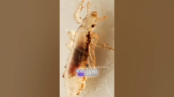 The Horrors of Head Lice