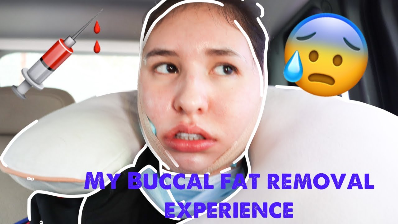 My Buccal Fat Removal Experience Part 2 Recovery