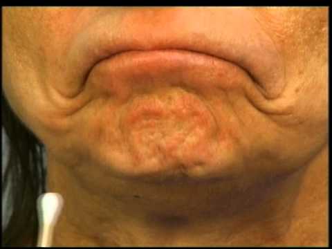 Instructions for Using Botox in the Chin by Dr. Elliott of Skinspirations