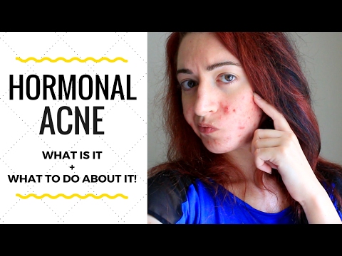 HORMONAL ACNE FACTS : What Is It, What Causes It & How To Treat it!