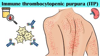 Immune Thrombocytopenic Purpura (ITP) - Causes, Pathogenesis, Signs & Symptoms, Diagnosis, Treatment