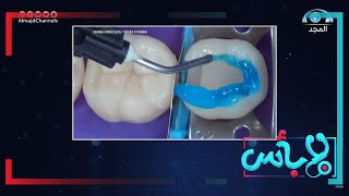 أنواع الحشو التجميلي للأسنان وشرح العملية كاملة بالفيديو | د. أحمد اسكندر