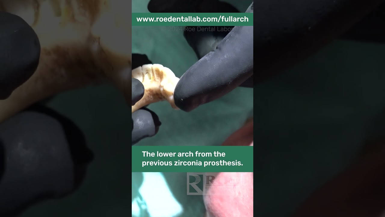 Lower Full Arch Surgery with Grammetry 