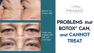 Facial Areas Botox Can and Cannot Treat