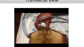 POCUS   Bladder