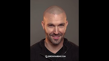 Scalp micropigmentation 6 years later..