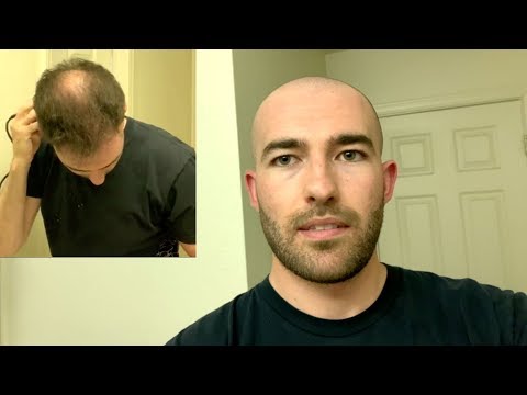 balding-in-my-20's---i-went-bald-shaved-my-head-and-this!-is-how-it-felt
