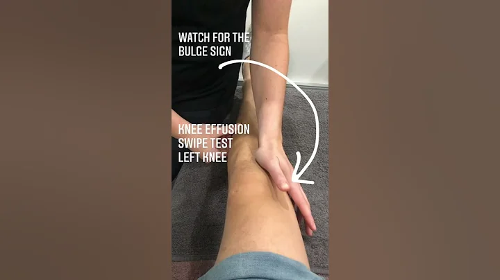 These videos show a positive “swipe test” or “stroke test” on both of these poor patients knees! - DayDayNews