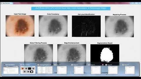 Skin Lesion Segmentation in Dermoscopic Images projects | Skin Lesion Segmentation Matlab Code