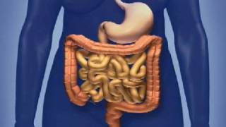 Screening for Colorectal Cancer