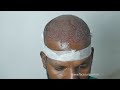 FUE Hair Transplant (3500 Grafts Vertex) By Dr. Sunil Richardson - Richardsons Hospital