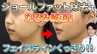 【口横の脂肪 1.5センチ摘める人必見】頬・アゴ下脂肪は除去して若返り＆たるみ解消！1回の手術で理想のフェイスラインに近づくための方法！【二重アゴ解消】【エラ張り】【ジョールファット】