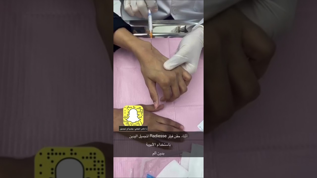 حقن الفيلر لليدين، لاستعادة النضارة والشباب