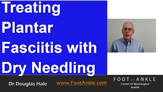 Dry Needling for Plantar Fasciitis | Seattle Podiatrist
