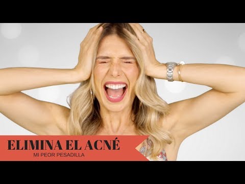 ELIMINA EL ACNE, TE DIGO COMO!