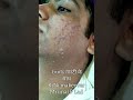 acne heal peel #vedios #skin #acne #acnetreatment #pimples #kinimakeover #reels
