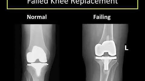 Knee Replacement Revision: Why, How and What to Expect