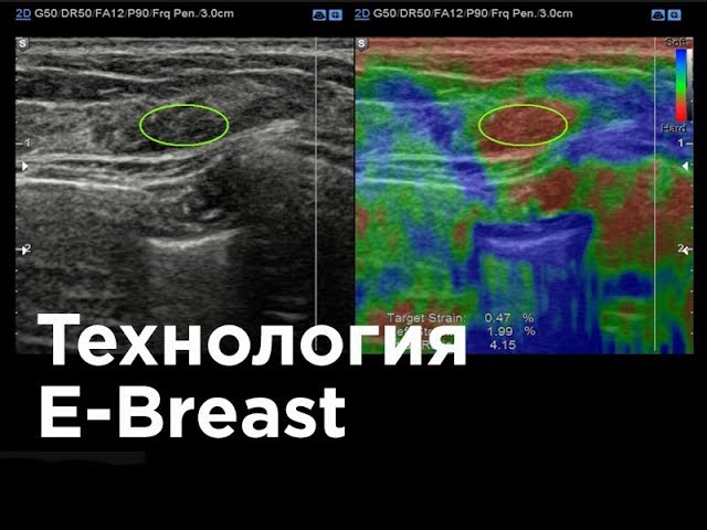 Технология E-Breast - эластография молочной железы