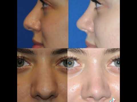 Video thumbnail: Rhinoplasty Before and After - Dr. Ali Totonchi — Dr. Ali Totonchi