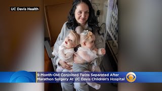 9-Month-Old Conjoined Twins Separated After Marathon Surgery At UC Davis Children’s Hospital