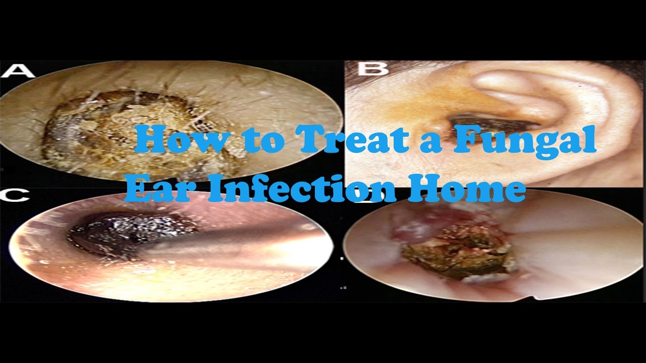 Fungal Ear Infection How To Treat A Fungal Ear Infection Home