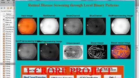 Retinal Disease Screening Through Local Binary Patterns - 1Crore Projects