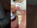 كيفية ازالة تسوس الاسنان 