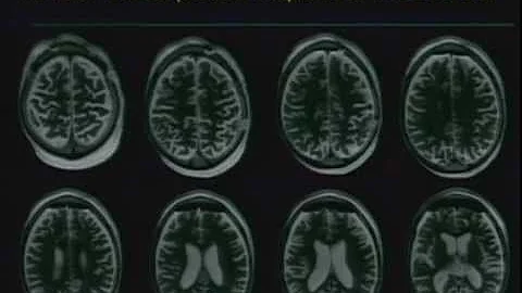 Batten Disease: Spotlight on Stem Cell Research - ...